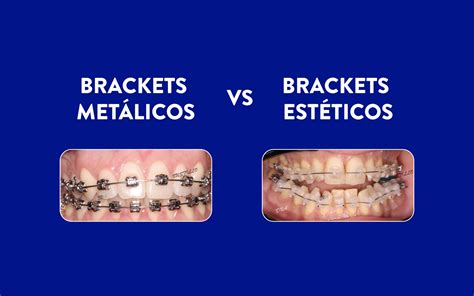 diferencias entre brackets metalicos y esteticos|Conoce las diferencias entre los Brackets metálicos y estéticos.